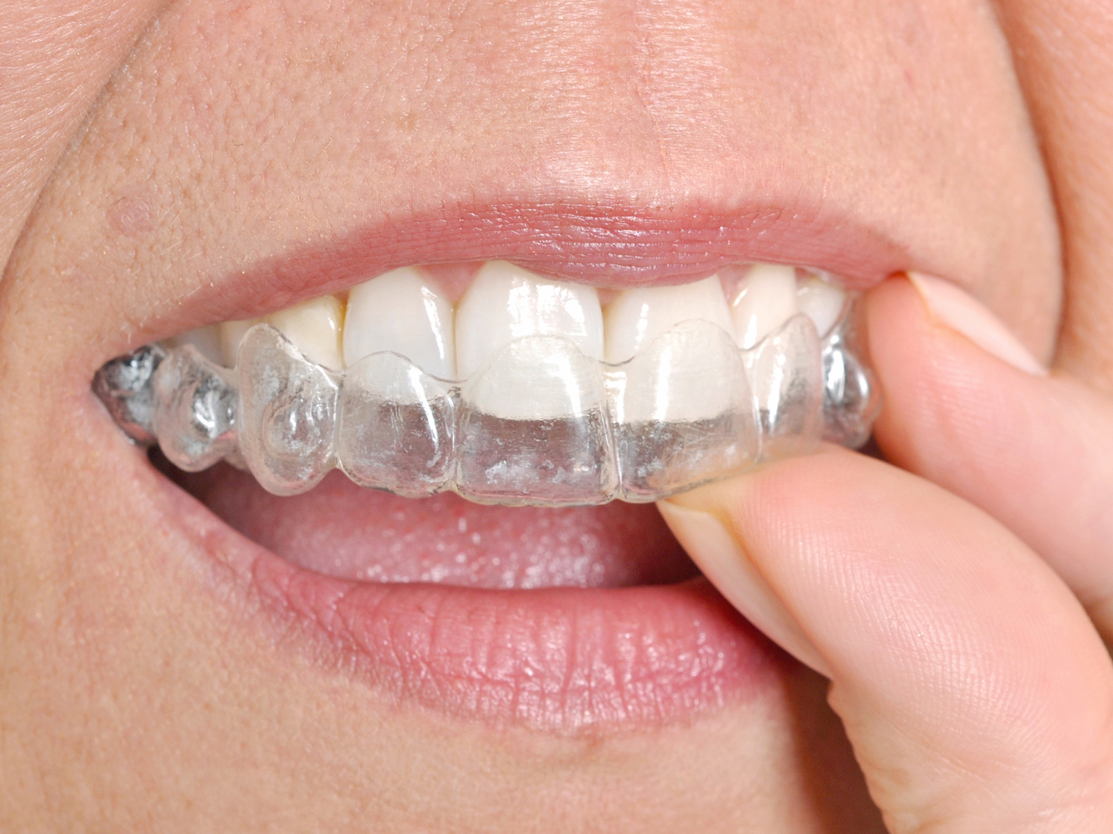 what-s-the-shortest-time-for-invisalign