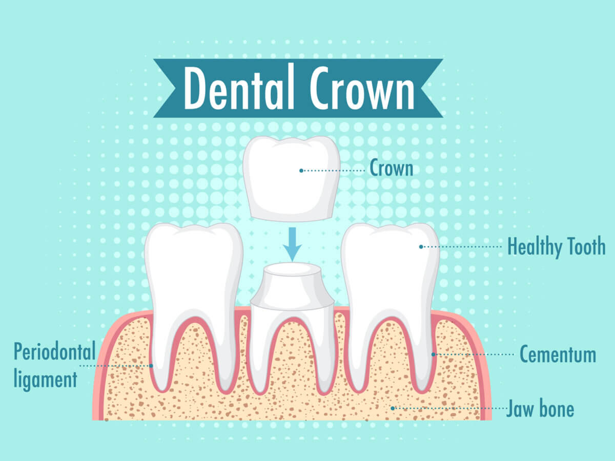 What are signs that I need a crown?