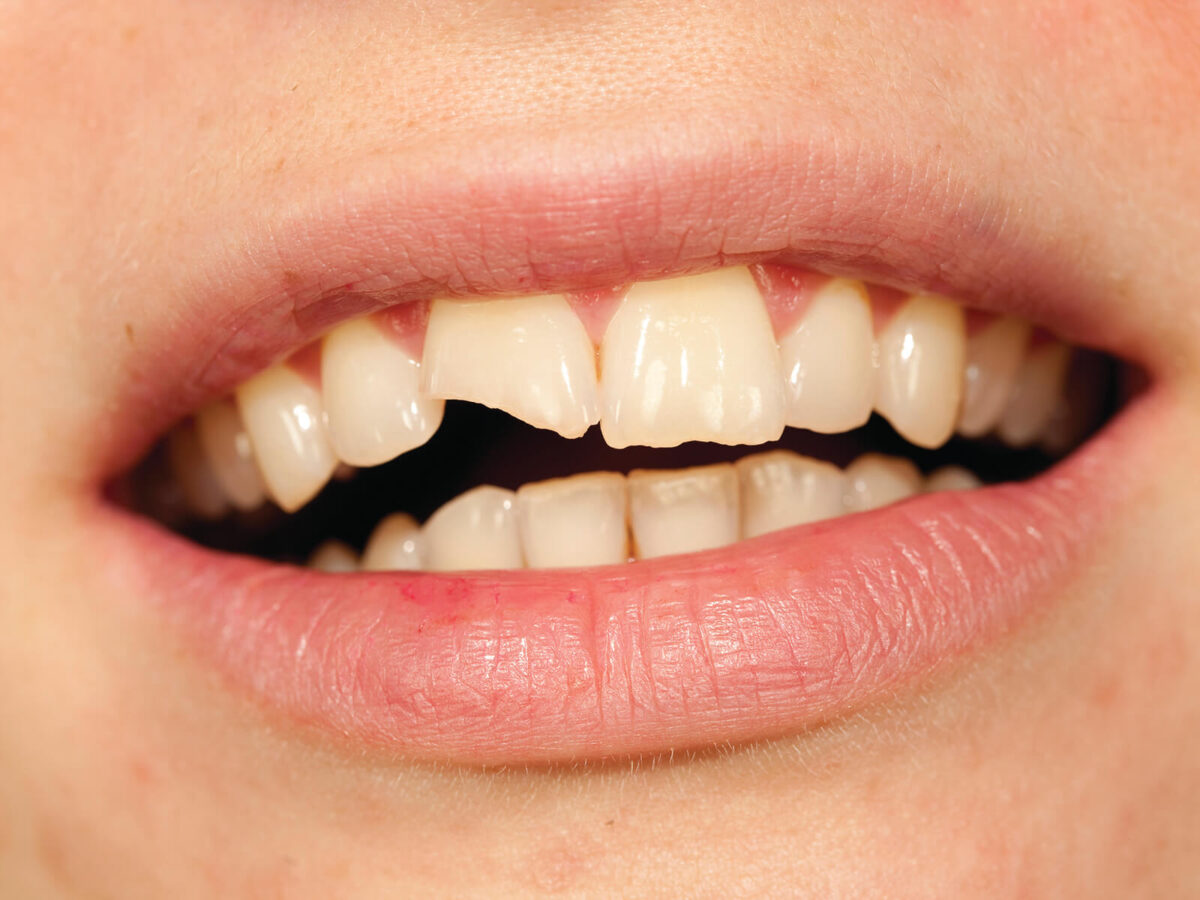 What Can You Do For A Chipped Tooth?