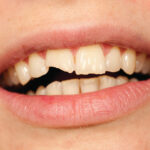 What Can You Do For A Chipped Tooth?