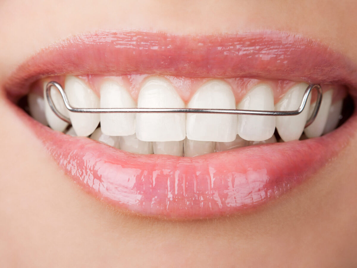 Retainers After Braces: Here’s Why Wearing Your Retainer Is So Important