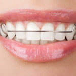 Retainers After Braces: Here’s Why Wearing Your Retainer Is So Important