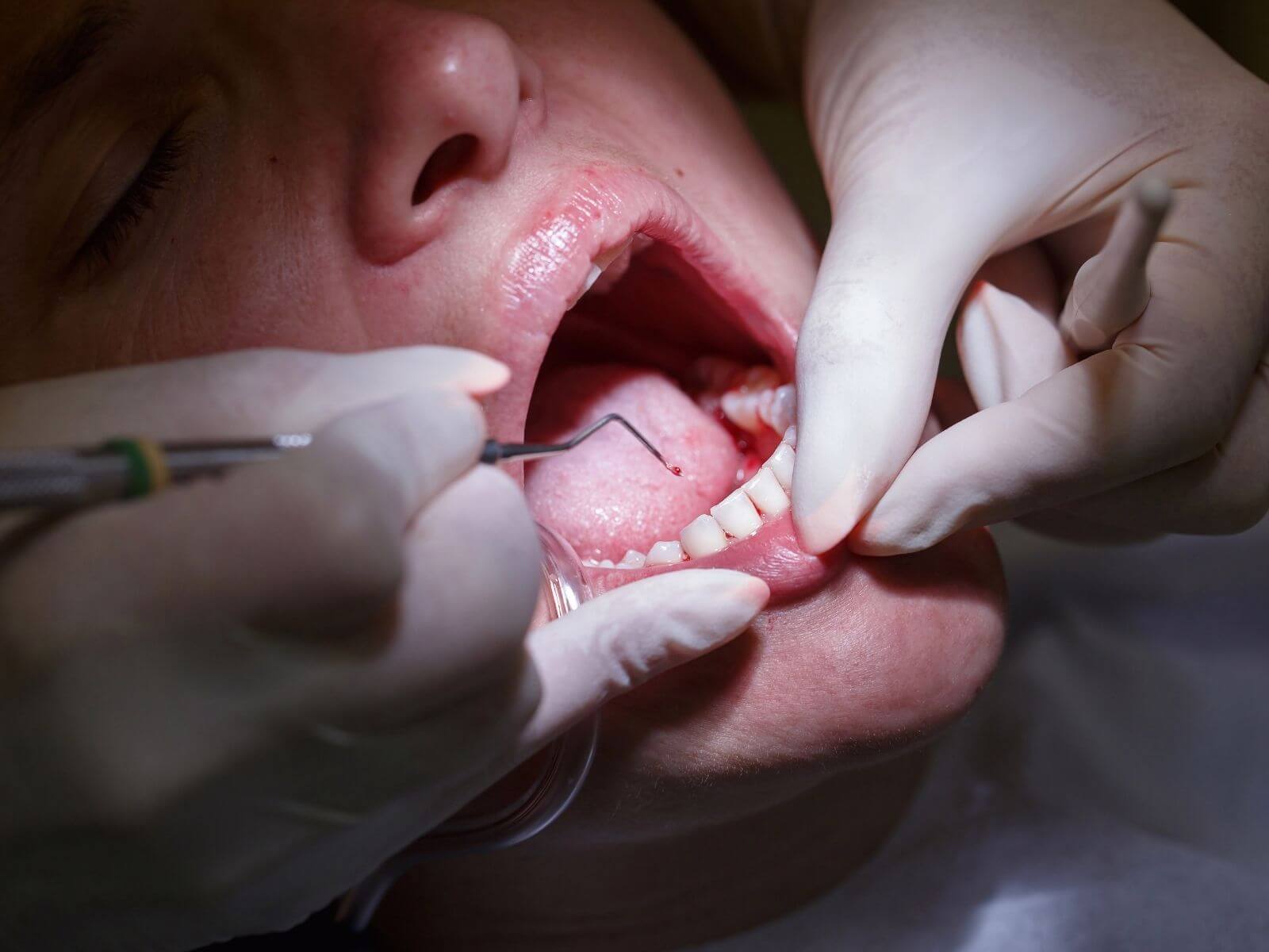 How To Prevent Early Periodontal Disease From Getting Worse